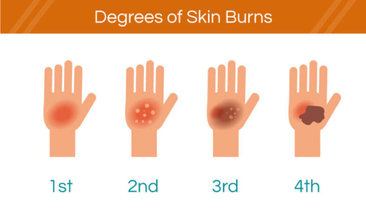 degrees of skin burn on hand